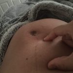 Beyond Surgery: Can Nutrition and Lifestyle Help Prevent Uterine Fibroids? by Vivian Obi, MPH